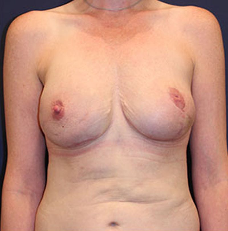 Breast Reconstruction Before & After Gallery - Patient 174163223 - Image 2