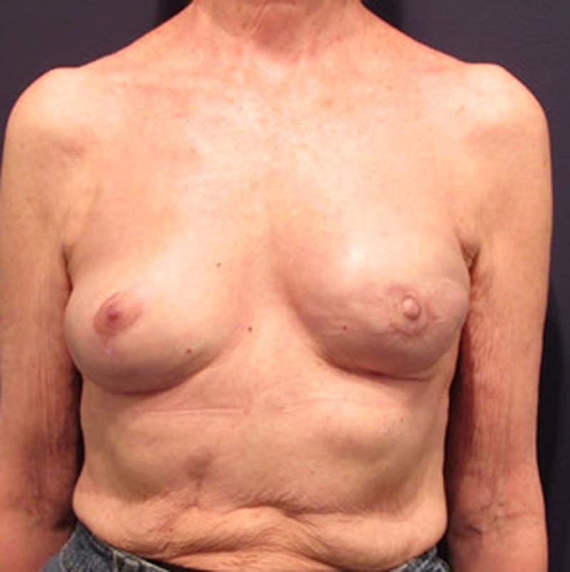 Breast Reconstruction Before & After Gallery - Patient 174163231 - Image 2