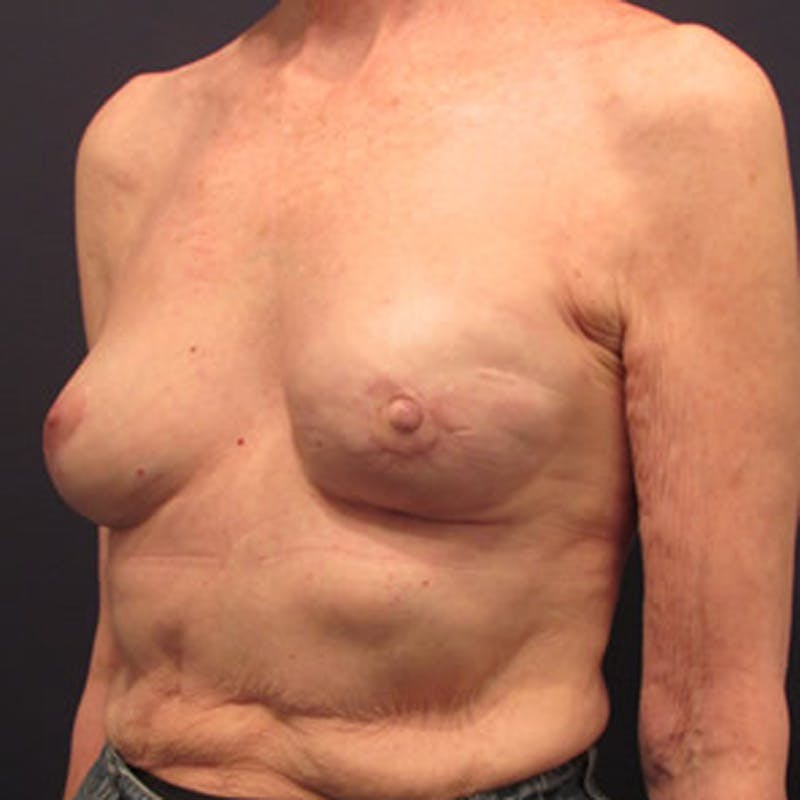 Breast Reconstruction Before & After Gallery - Patient 174163231 - Image 6