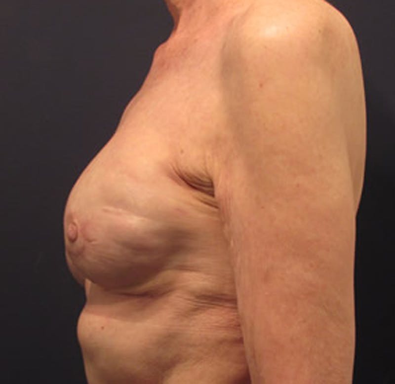 Breast Reconstruction Before & After Gallery - Patient 174163231 - Image 8