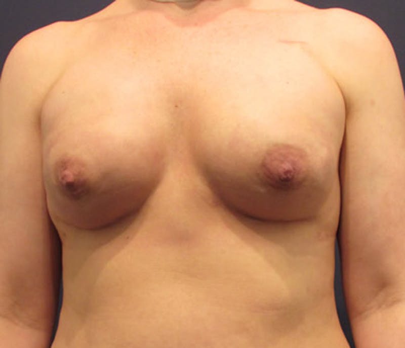 Breast Reconstruction Before & After Gallery - Patient 174163238 - Image 2