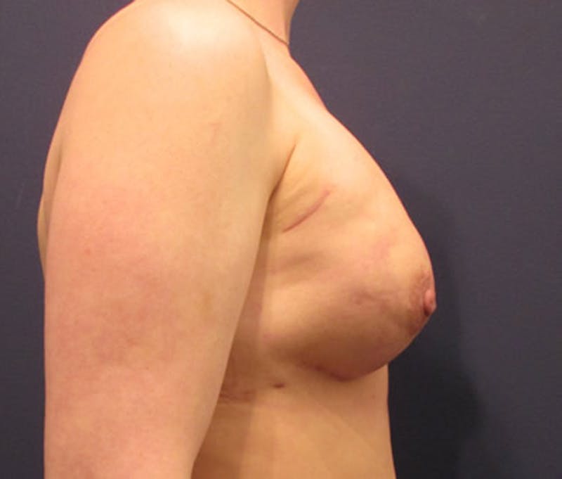 Breast Reconstruction Before & After Gallery - Patient 174163238 - Image 6
