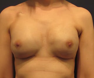 Breast Reconstruction Before & After Gallery - Patient 174163243 - Image 2