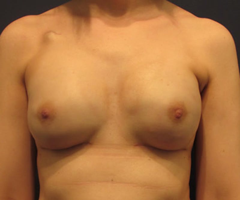 Breast Reconstruction Before & After Gallery - Patient 174163243 - Image 2