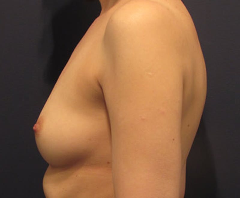 Breast Reconstruction Before & After Gallery - Patient 174163243 - Image 5