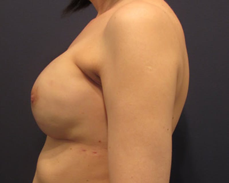 Breast Reconstruction Before & After Gallery - Patient 174163243 - Image 6