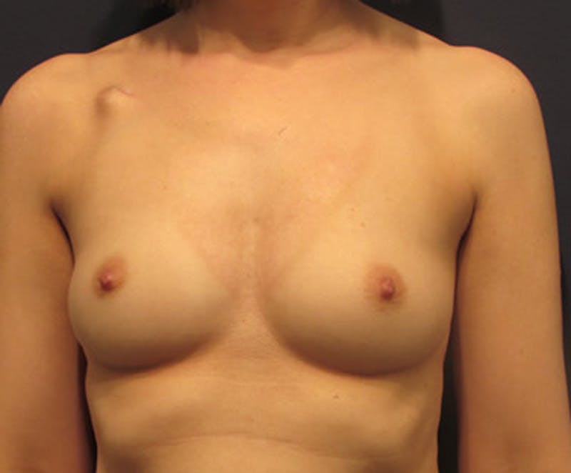 Breast Reconstruction Before & After Gallery - Patient 174163251 - Image 1