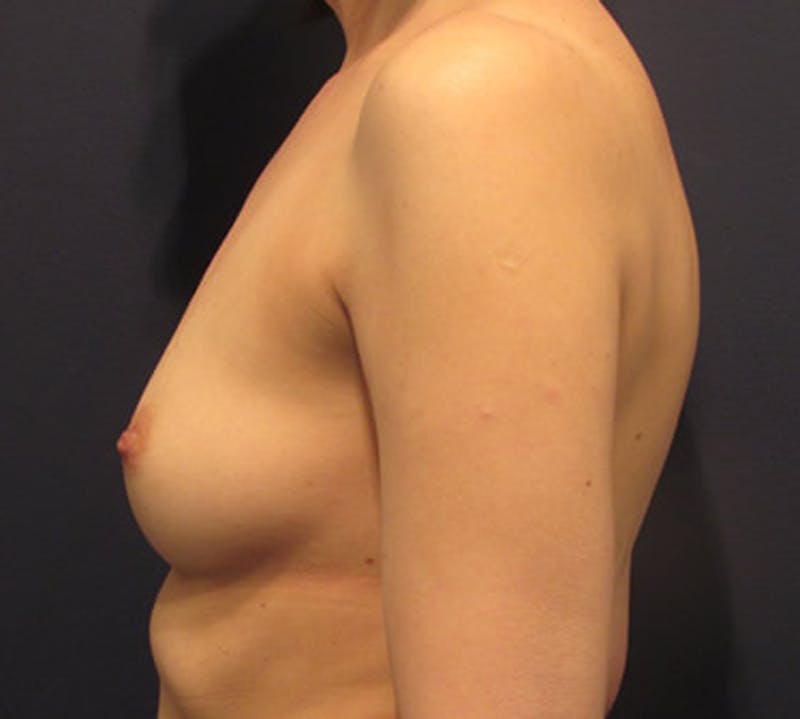 Breast Reconstruction Before & After Gallery - Patient 174163251 - Image 5