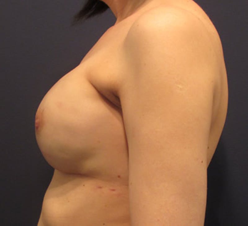 Breast Reconstruction Before & After Gallery - Patient 174163251 - Image 6