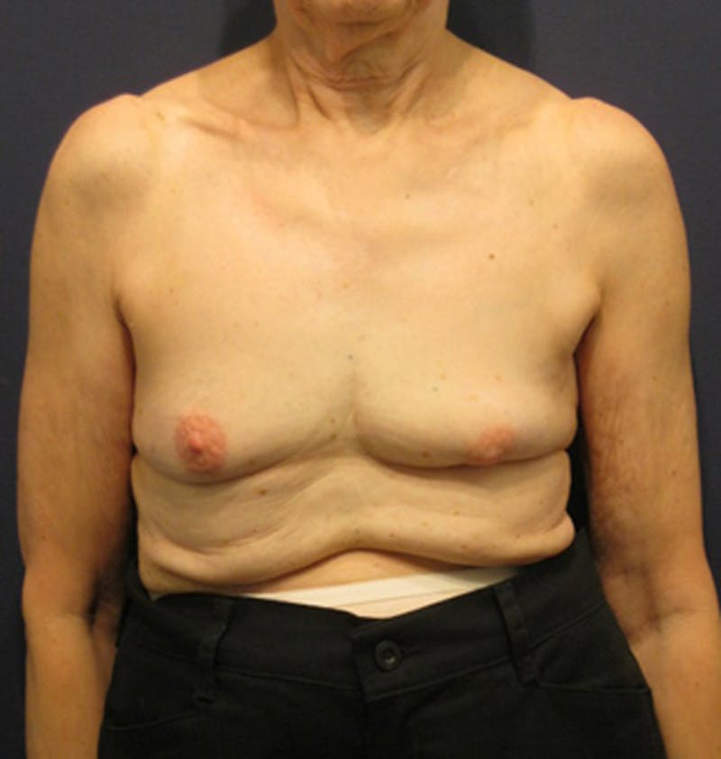 Breast Reconstruction Before & After Gallery - Patient 174163259 - Image 1