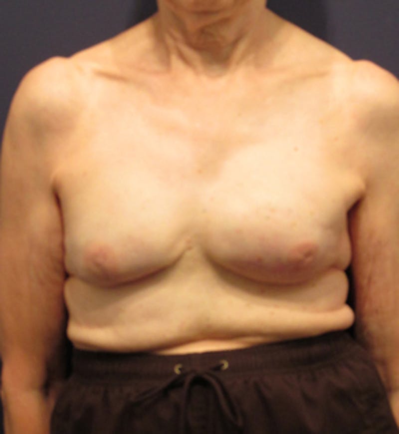 Breast Reconstruction Before & After Gallery - Patient 174163259 - Image 2