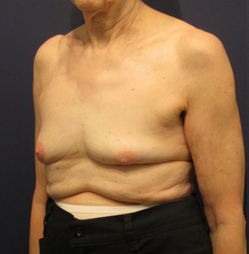 Breast Reconstruction Before & After Gallery - Patient 174163259 - Image 3