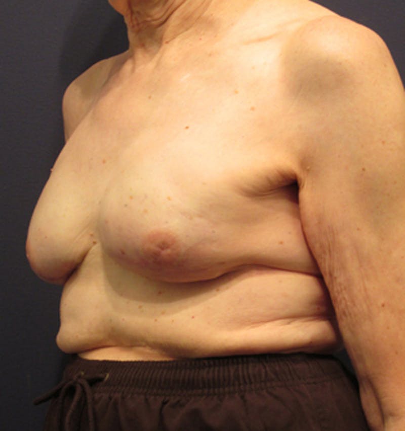 Breast Reconstruction Before & After Gallery - Patient 174163259 - Image 4