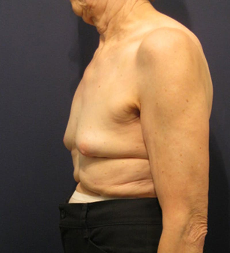 Breast Reconstruction Before & After Gallery - Patient 174163259 - Image 5