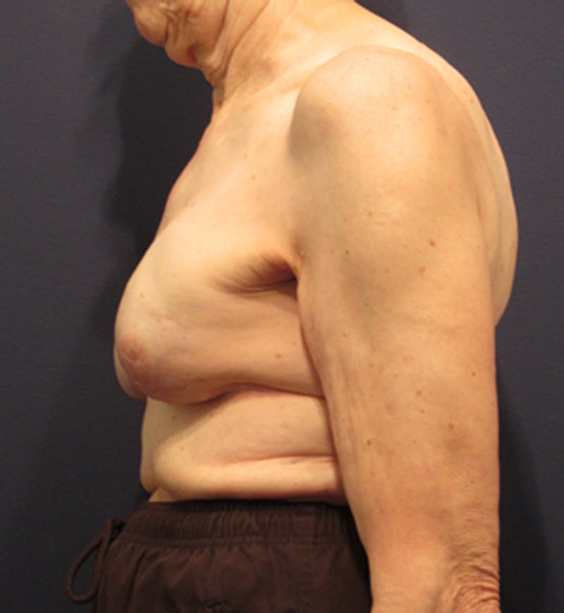 Breast Reconstruction Before & After Gallery - Patient 174163259 - Image 6