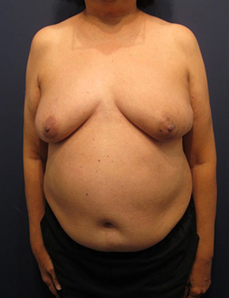 Breast Reconstruction Before & After Gallery - Patient 174163268 - Image 1