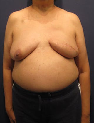Breast Reconstruction Before & After Gallery - Patient 174163268 - Image 2