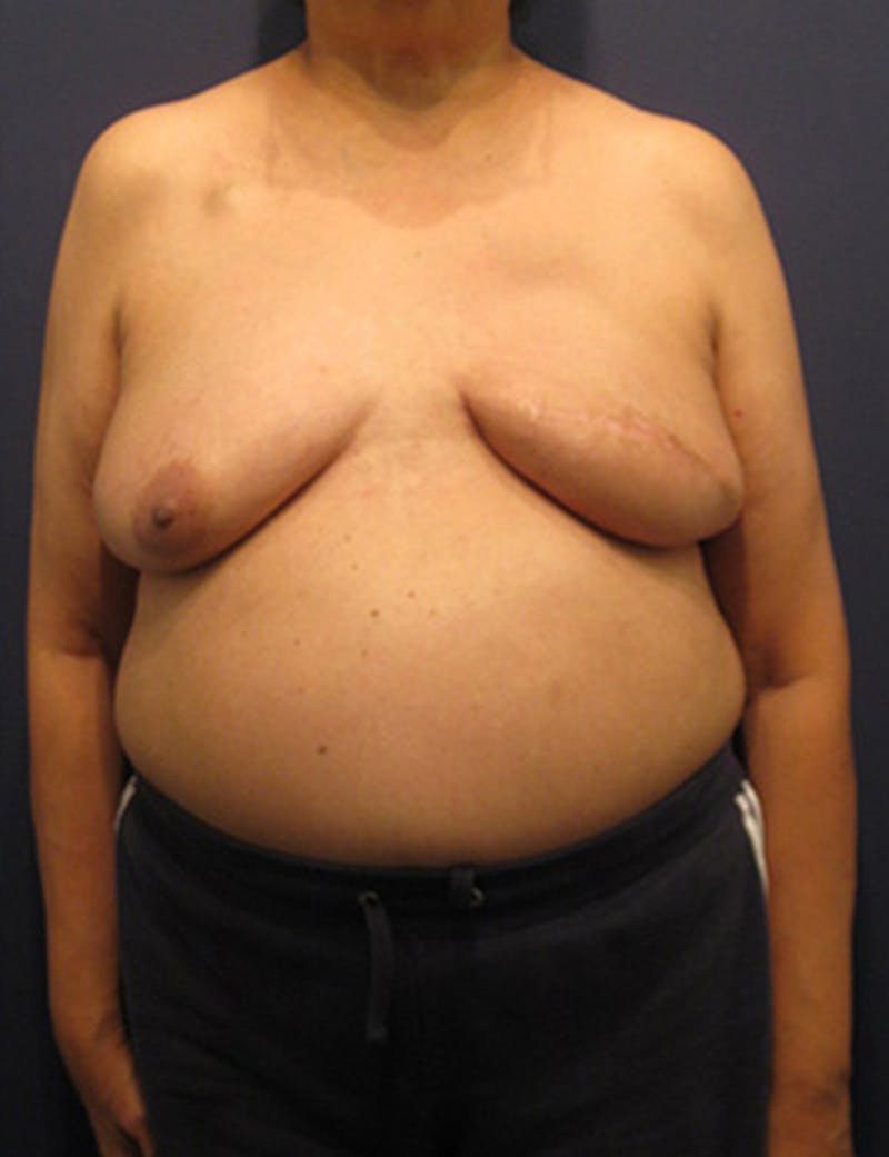 Breast Reconstruction Before & After Gallery - Patient 174163268 - Image 2
