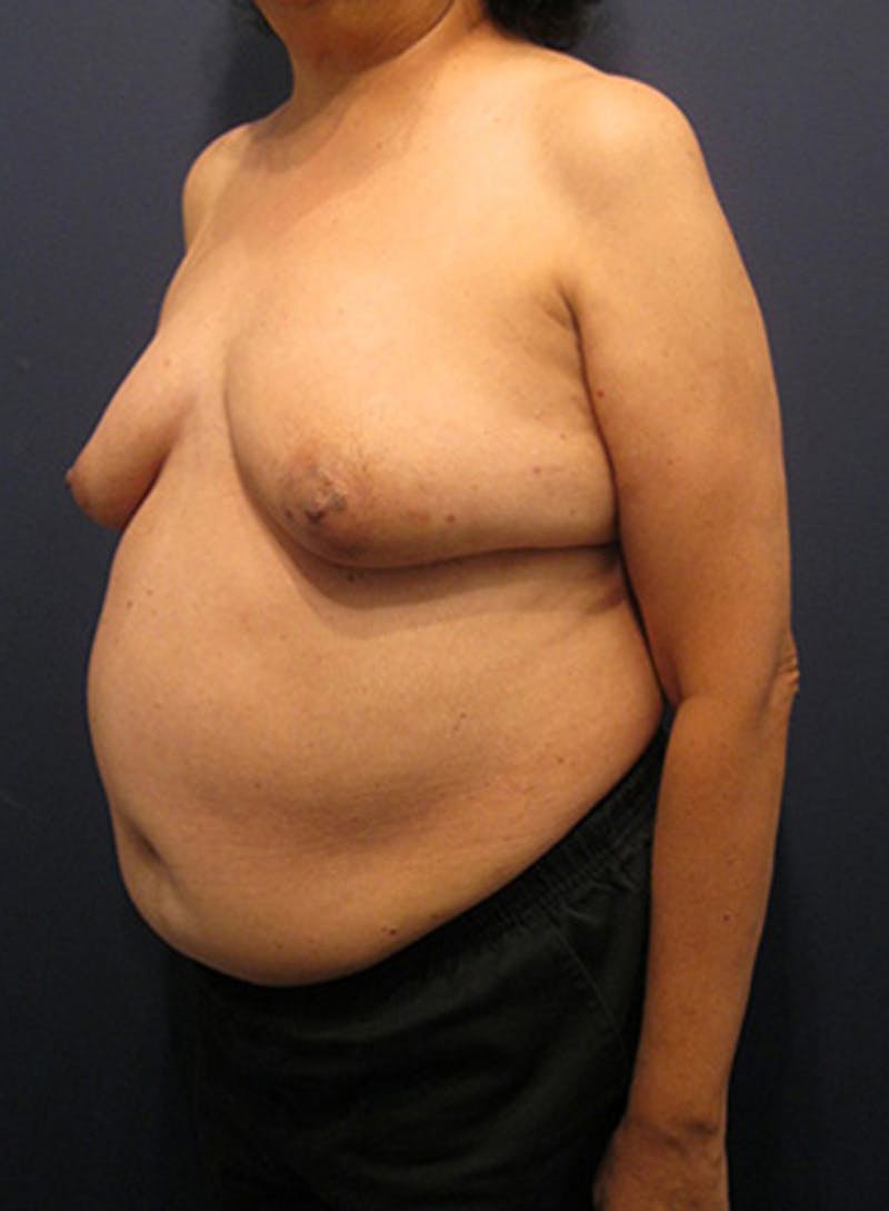 Breast Reconstruction Before & After Gallery - Patient 174163268 - Image 3