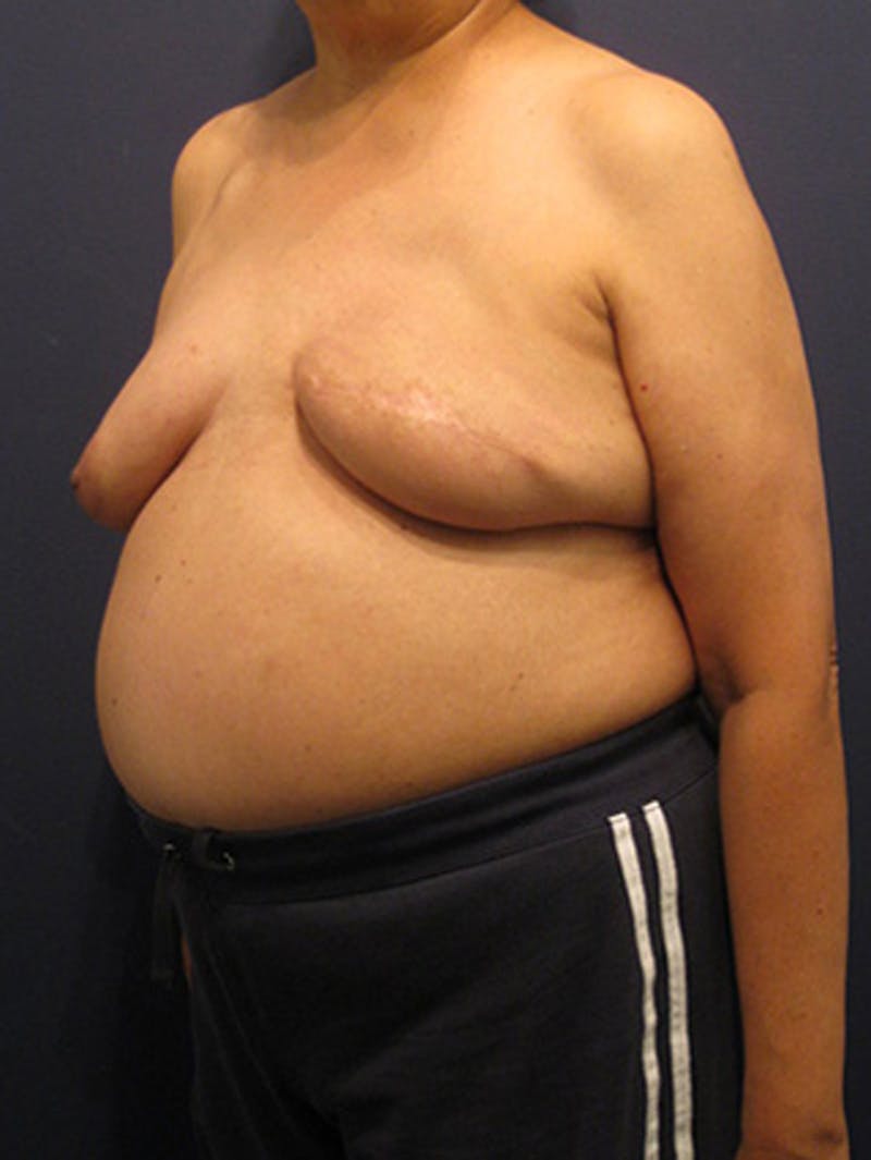 Breast Reconstruction Before & After Gallery - Patient 174163268 - Image 4