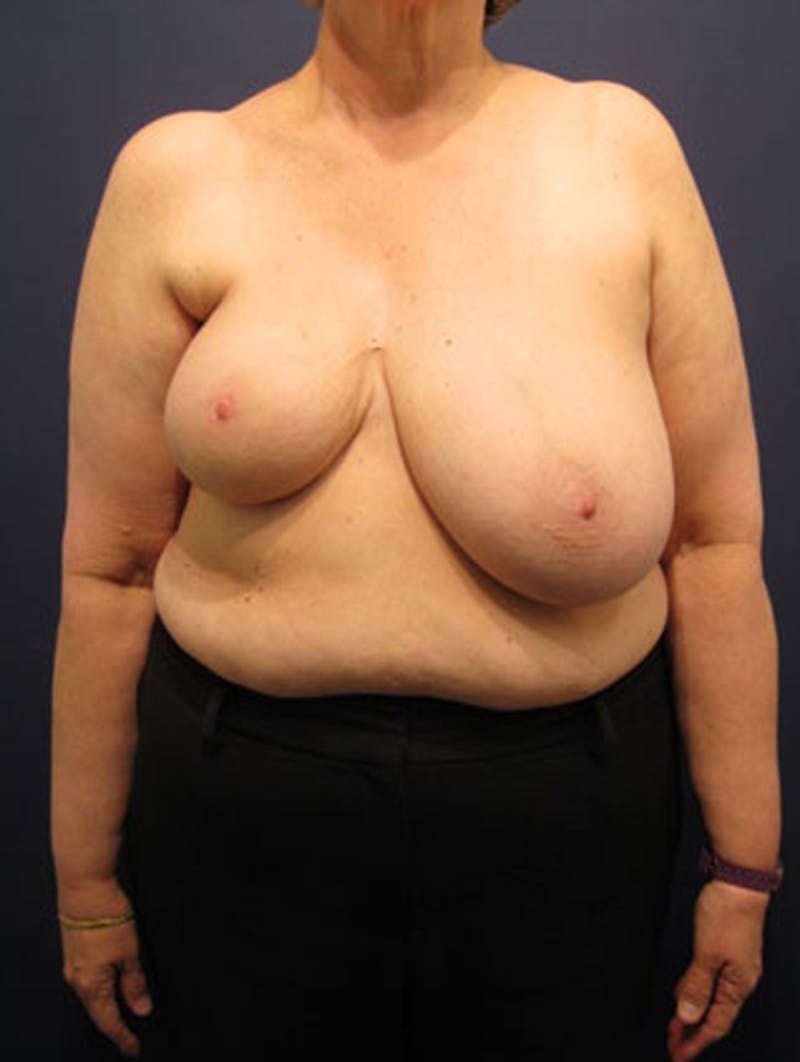 Breast Reconstruction Before & After Gallery - Patient 174163276 - Image 1