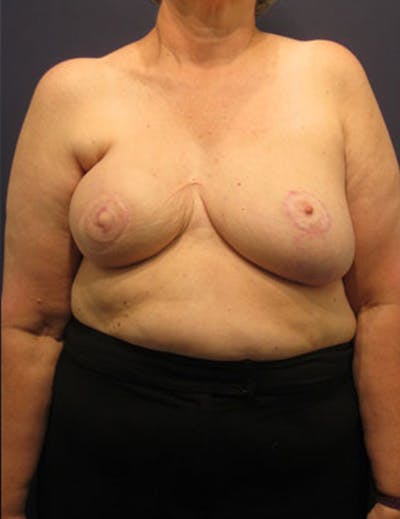 Breast Reconstruction Before & After Gallery - Patient 174163276 - Image 2