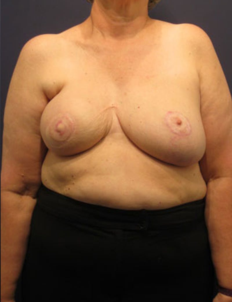 Breast Reconstruction Before & After Gallery - Patient 174163276 - Image 2
