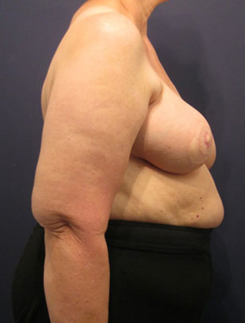 Breast Reconstruction Before & After Gallery - Patient 174163276 - Image 3