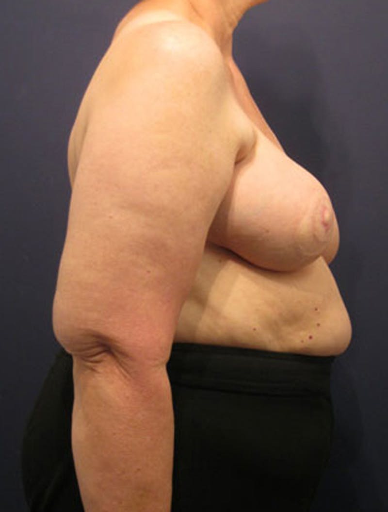 Breast Reconstruction Before & After Gallery - Patient 174163276 - Image 4