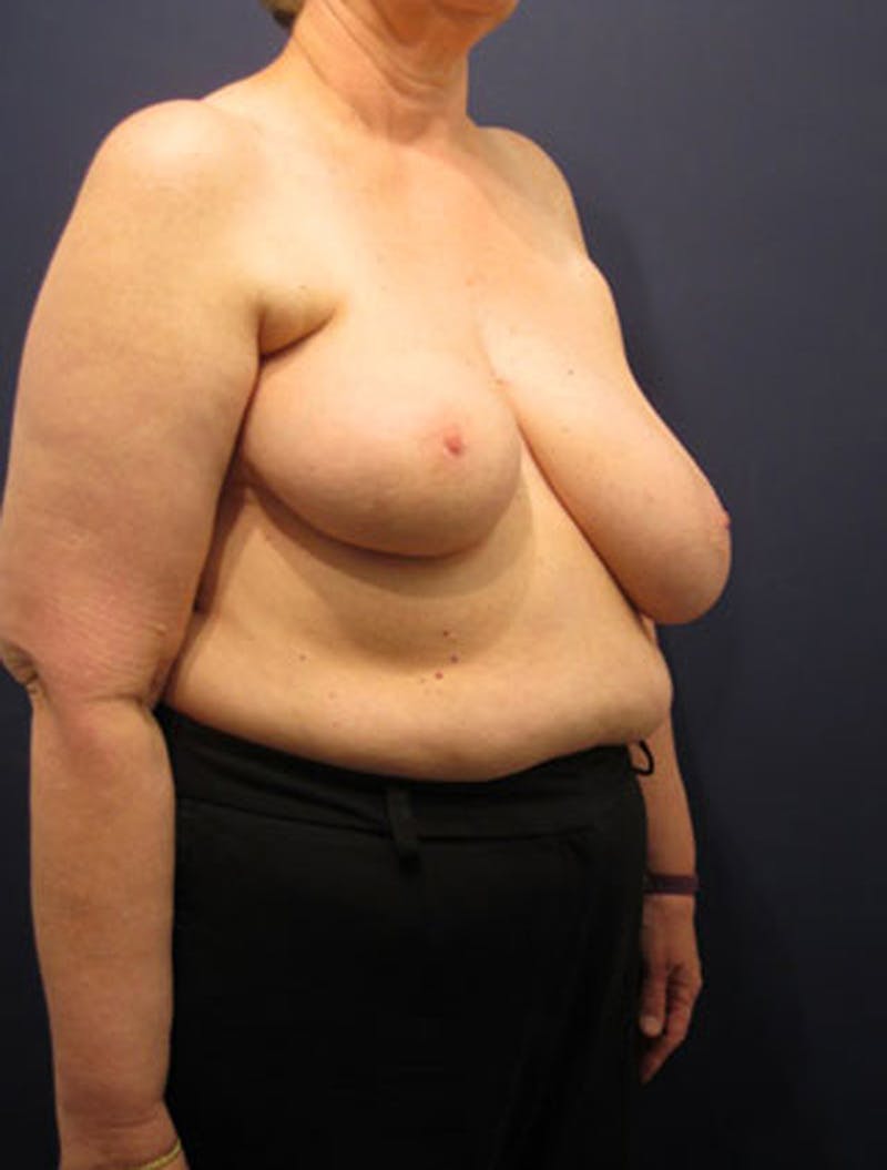 Breast Reconstruction Before & After Gallery - Patient 174163276 - Image 5