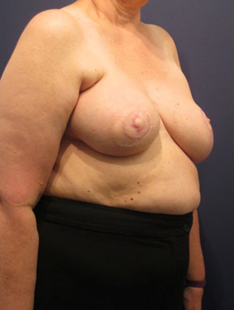 Breast Reconstruction Before & After Gallery - Patient 174163276 - Image 6