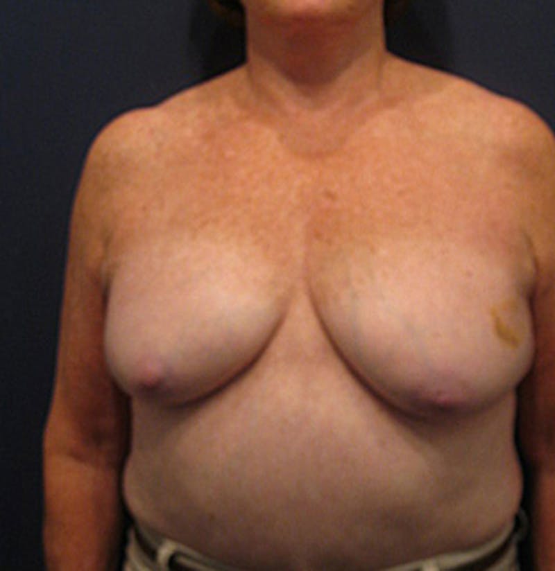 Breast Reconstruction Before & After Gallery - Patient 174163284 - Image 1