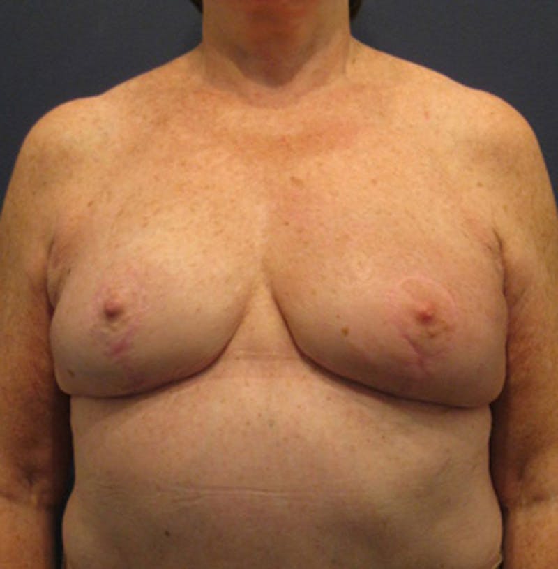 Breast Reconstruction Before & After Gallery - Patient 174163284 - Image 2