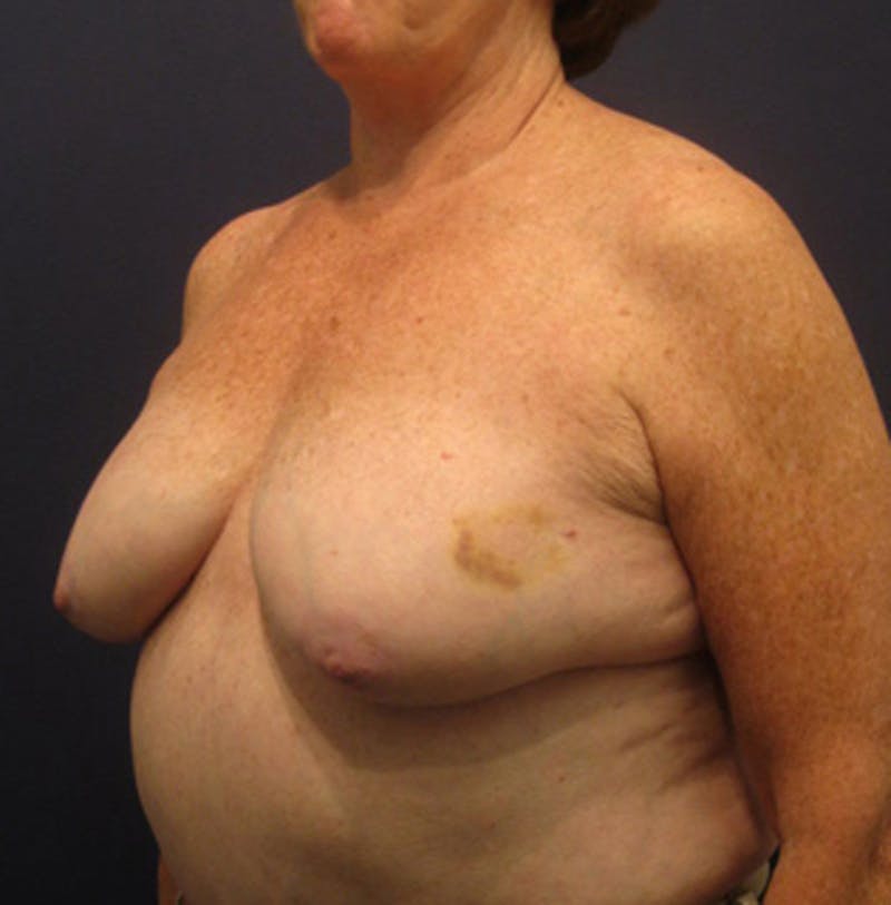 Breast Reconstruction Before & After Gallery - Patient 174163284 - Image 3