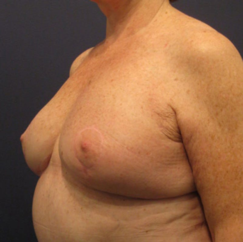 Breast Reconstruction Before & After Gallery - Patient 174163284 - Image 4