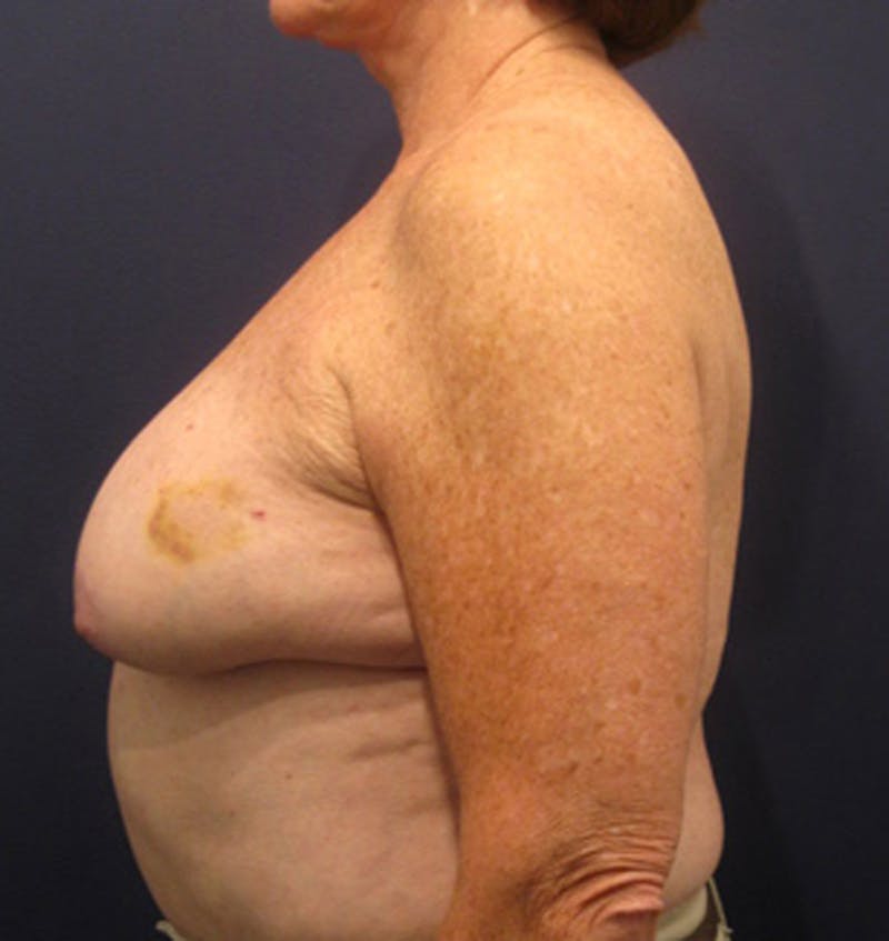 Breast Reconstruction Before & After Gallery - Patient 174163284 - Image 5
