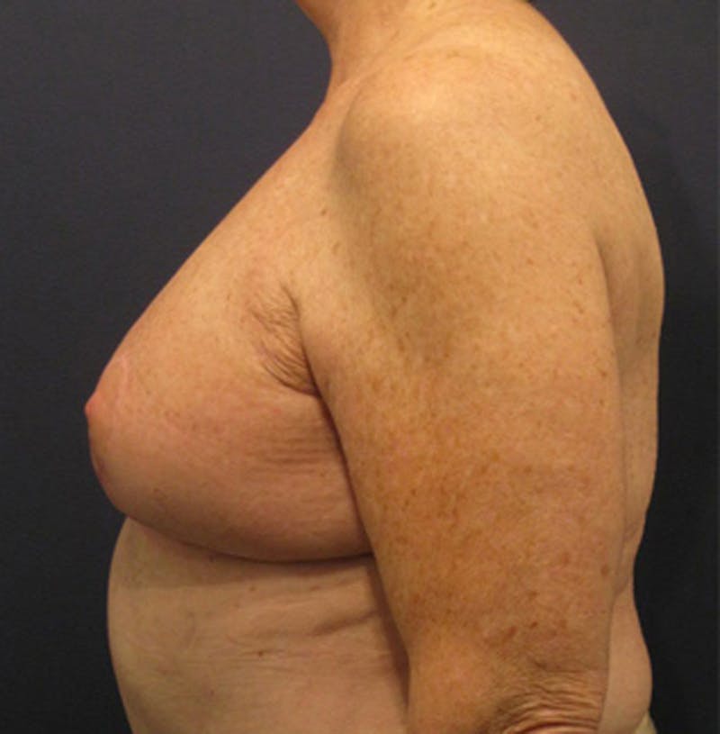 Breast Reconstruction Before & After Gallery - Patient 174163284 - Image 6