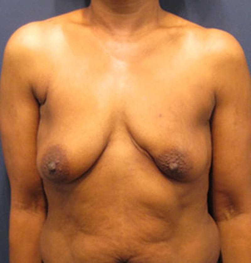 Breast Reconstruction Before & After Gallery - Patient 174163298 - Image 1
