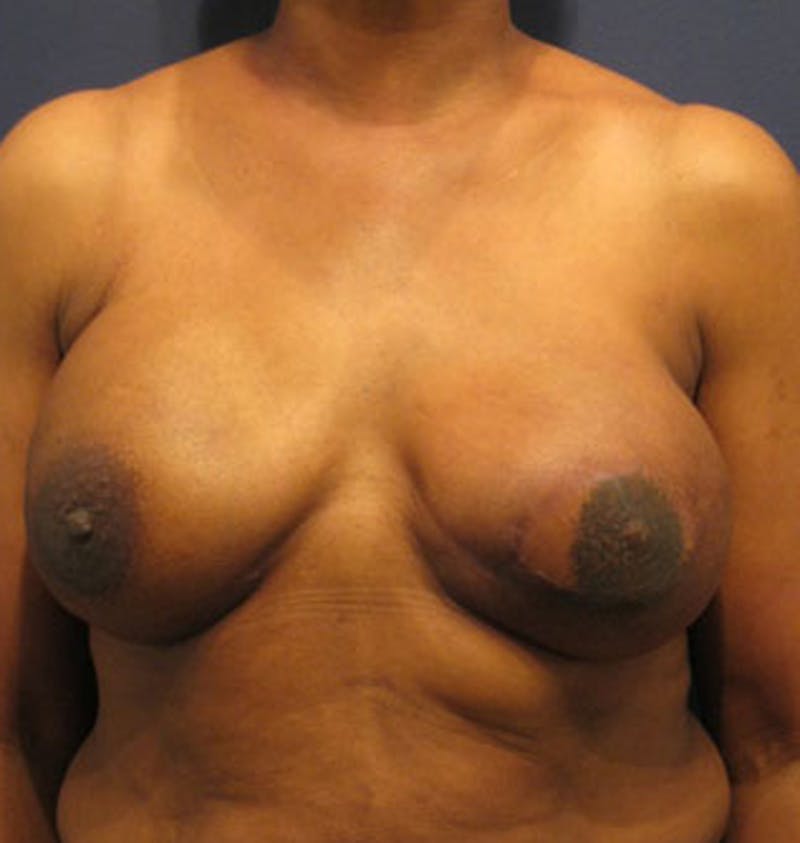 Breast Reconstruction Before & After Gallery - Patient 174163298 - Image 2