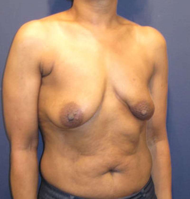 Breast Reconstruction Before & After Gallery - Patient 174163298 - Image 3