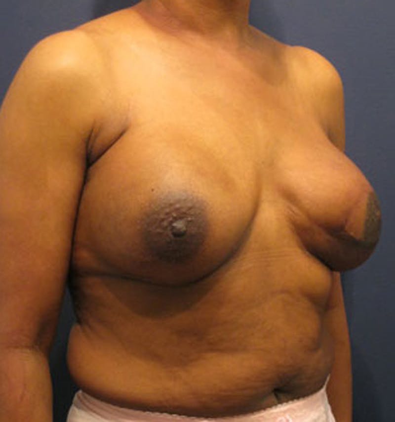 Breast Reconstruction Before & After Gallery - Patient 174163298 - Image 4