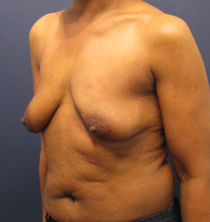 Breast Reconstruction Before & After Gallery - Patient 174163298 - Image 5