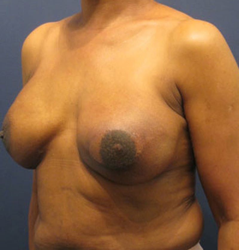 Breast Reconstruction Before & After Gallery - Patient 174163298 - Image 6
