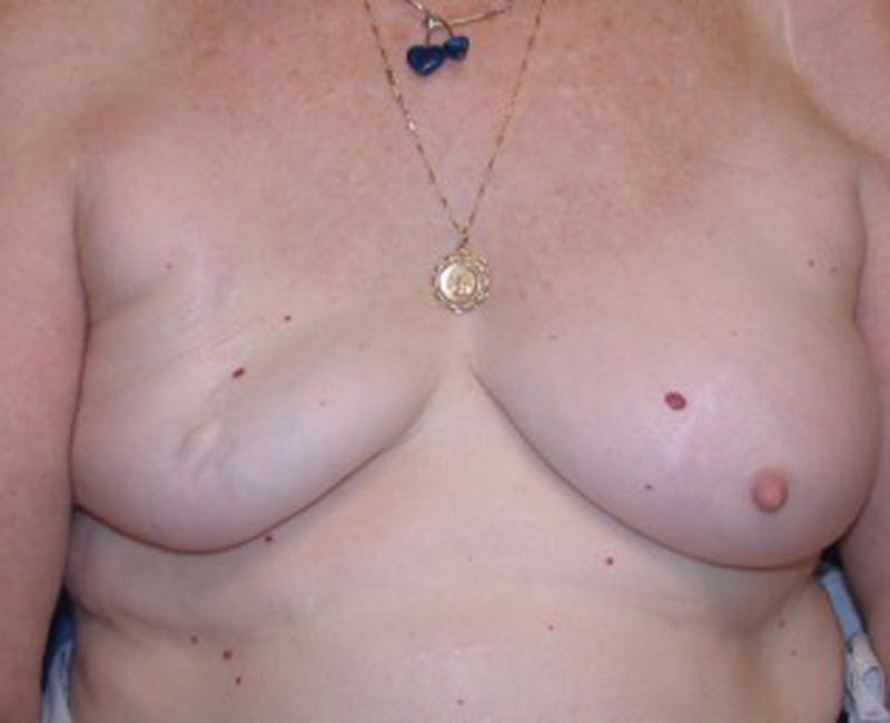Breast Reconstruction Before & After Gallery - Patient 174163313 - Image 1
