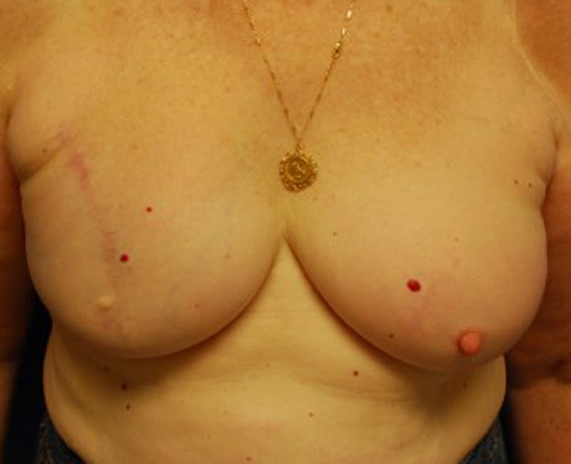 Breast Reconstruction Before & After Gallery - Patient 174163313 - Image 2