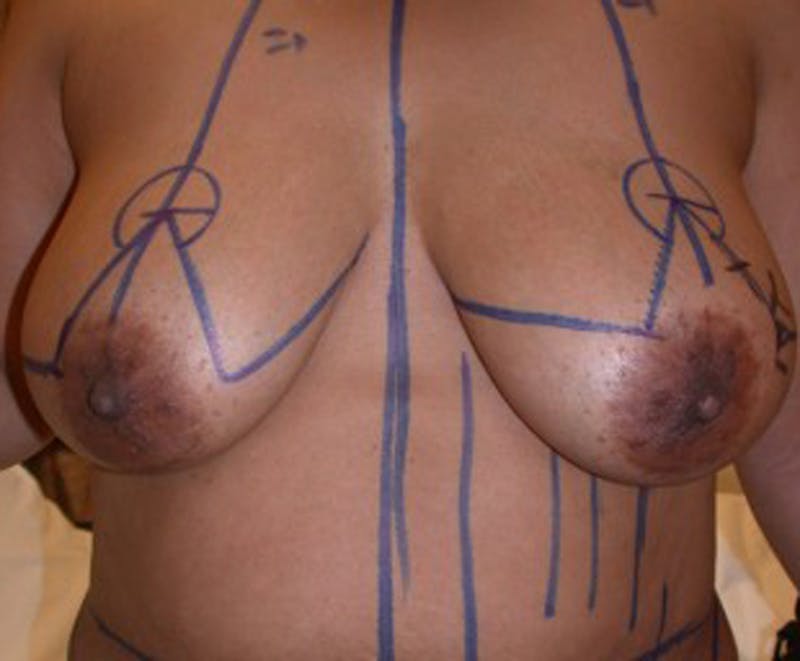 Breast Reconstruction Before & After Gallery - Patient 174163320 - Image 1