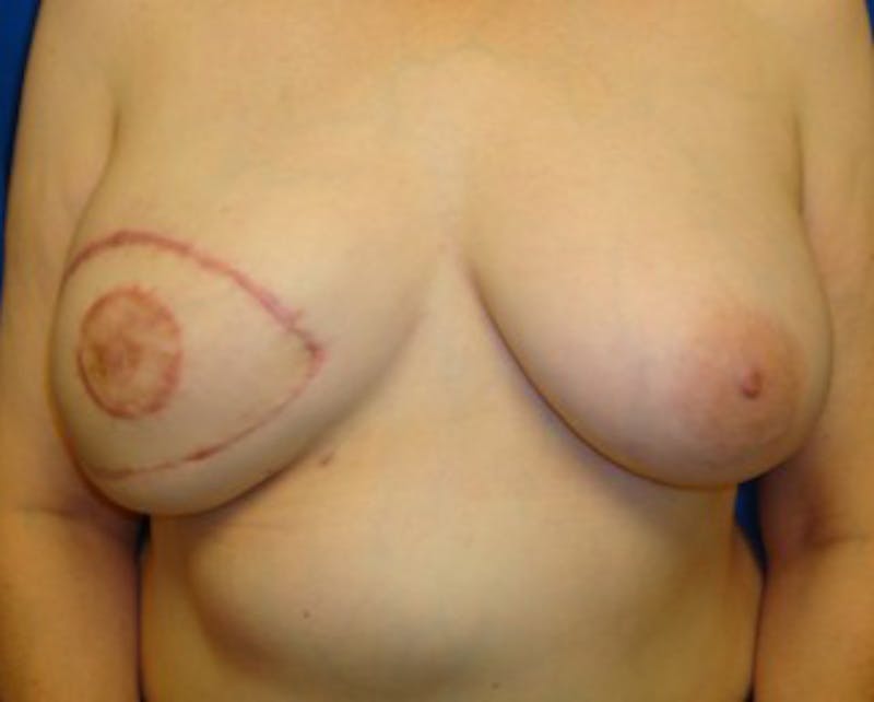 Breast Reconstruction Before & After Gallery - Patient 174164399 - Image 2
