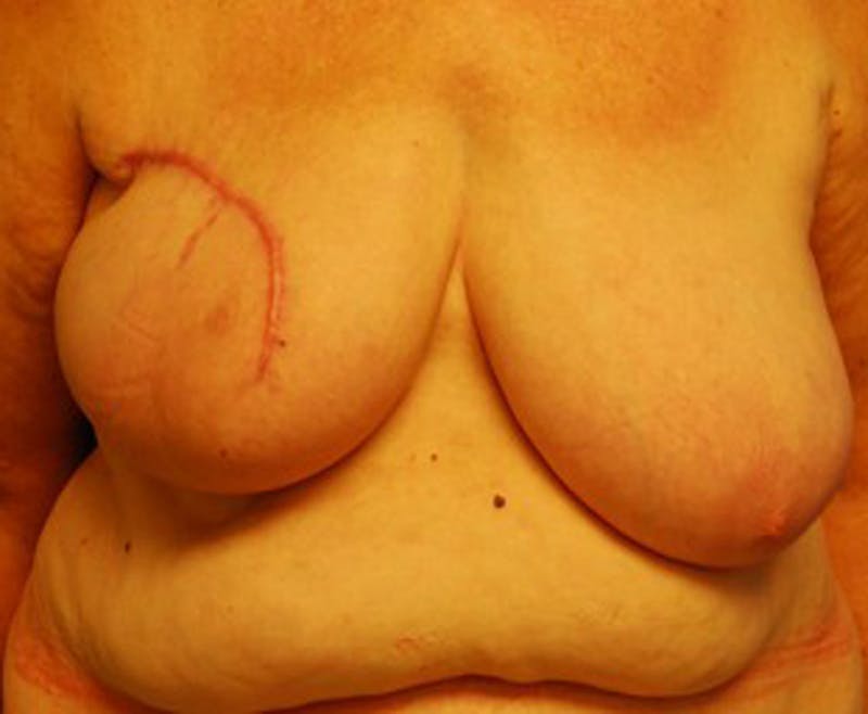 Breast Reconstruction Before & After Gallery - Patient 174164405 - Image 1