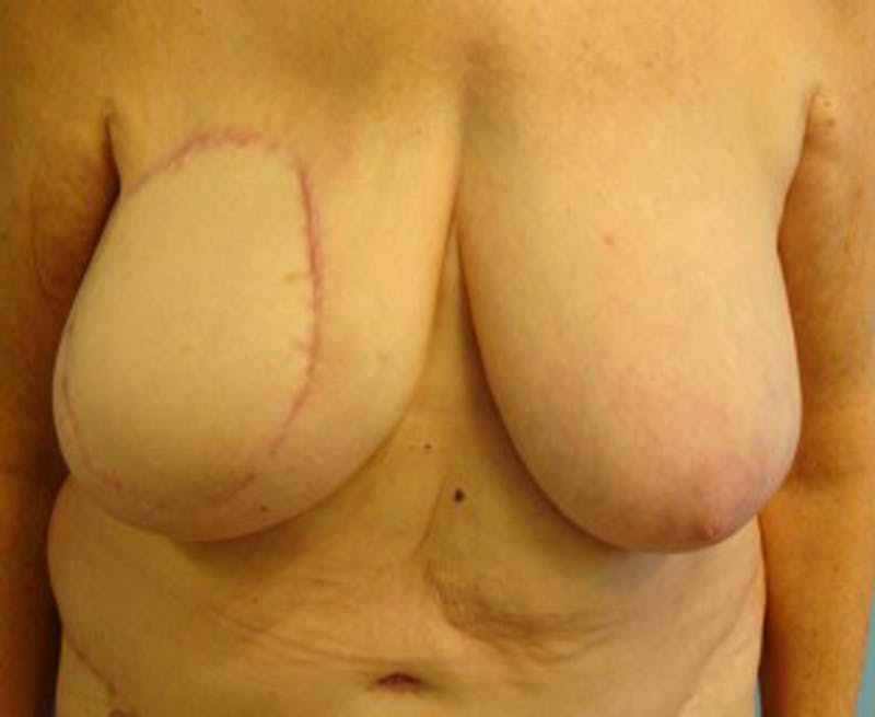 Breast Reconstruction Before & After Gallery - Patient 174164405 - Image 2