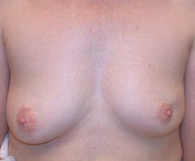 Breast Reconstruction Before & After Gallery - Patient 174164412 - Image 1